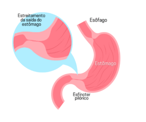 Estenose pilórica em adultos: sintomas e tratamento